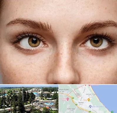 متخصص انحراف چشم در رودسر