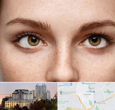 متخصص انحراف چشم در فرشته 