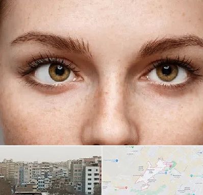 متخصص انحراف چشم در محمد شهر کرج 