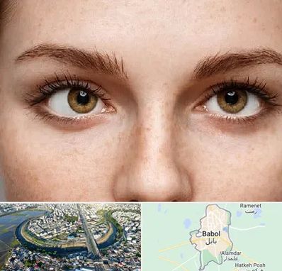 متخصص انحراف چشم در بابل