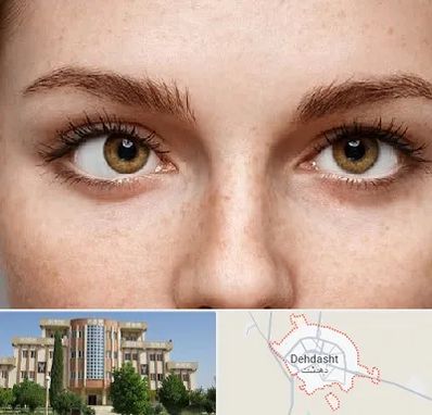 متخصص انحراف چشم در دهدشت