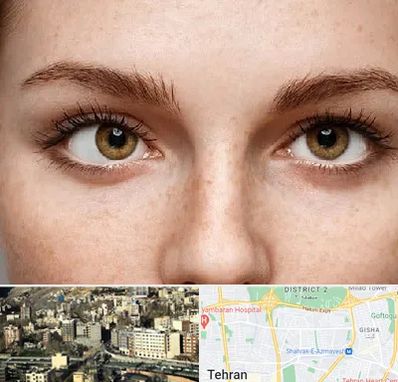 متخصص انحراف چشم در مرزداران 