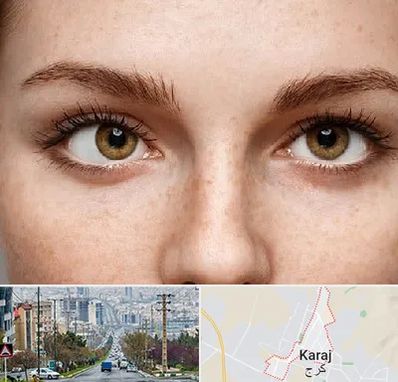 متخصص انحراف چشم در گوهردشت کرج 