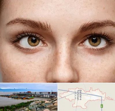 متخصص انحراف چشم در بندر ترکمن