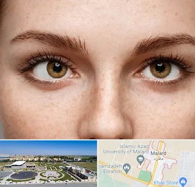 متخصص انحراف چشم در ملارد