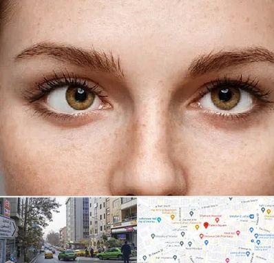 متخصص انحراف چشم در فاطمی 