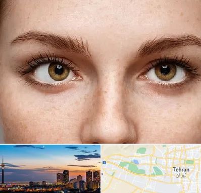 متخصص انحراف چشم در غرب تهران 