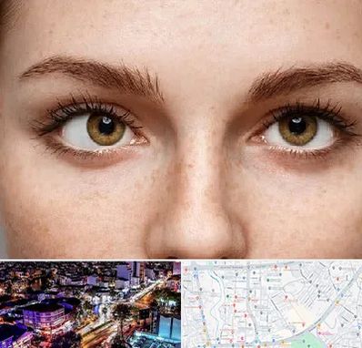 متخصص انحراف چشم در منظریه رشت