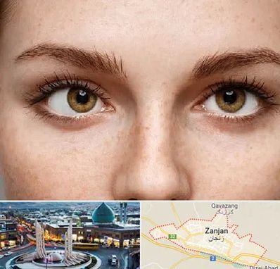 متخصص انحراف چشم در زنجان