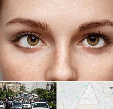 متخصص انحراف چشم در سیدی مشهد