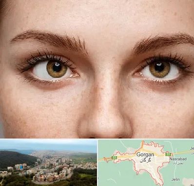 متخصص انحراف چشم در گرگان