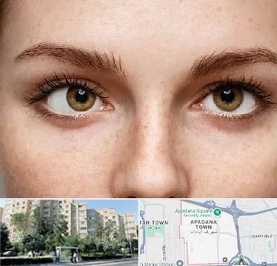 متخصص انحراف چشم در آپادانا