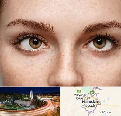 متخصص انحراف چشم در همدان