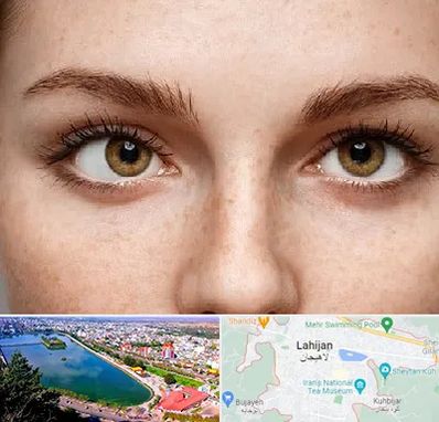 متخصص انحراف چشم در لاهیجان