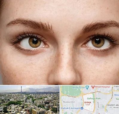 متخصص انحراف چشم در گیشا 