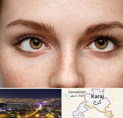 متخصص انحراف چشم در کرج