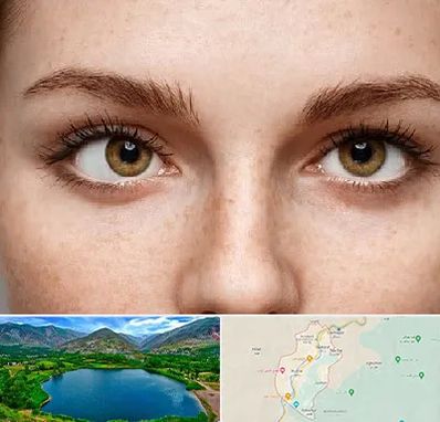 متخصص انحراف چشم در رودبار