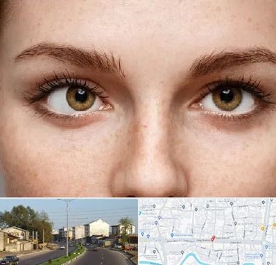 متخصص انحراف چشم در ضیابری رشت