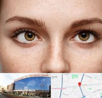 متخصص انحراف چشم در نصف راه تبریز