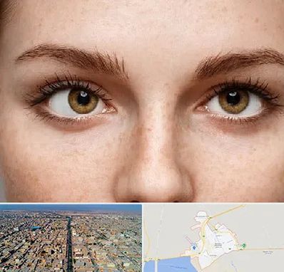 متخصص انحراف چشم در بندر ماهشهر