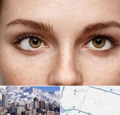 متخصص انحراف چشم در ازگل