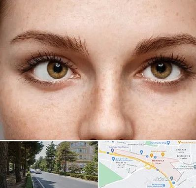 متخصص انحراف چشم در مهرویلا کرج