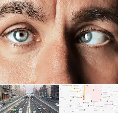 فوق تخصص استرابیسم در توحید 