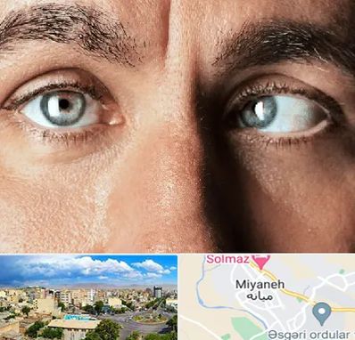 فوق تخصص استرابیسم در میانه