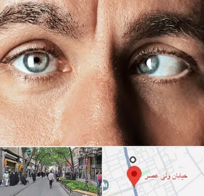 فوق تخصص استرابیسم در ولیعصر شهریار