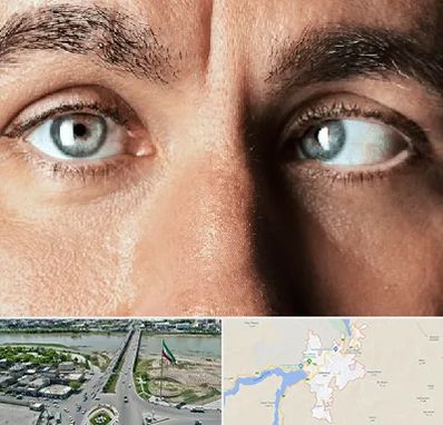 فوق تخصص استرابیسم در میاندوآب