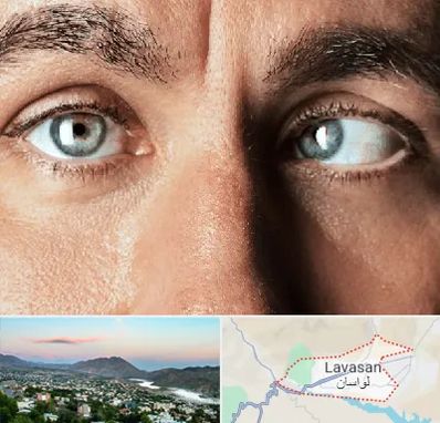 فوق تخصص استرابیسم در لواسان