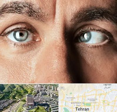 فوق تخصص استرابیسم در شمال تهران 