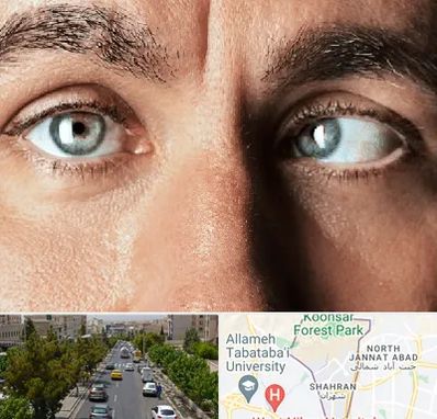 فوق تخصص استرابیسم در شهران 