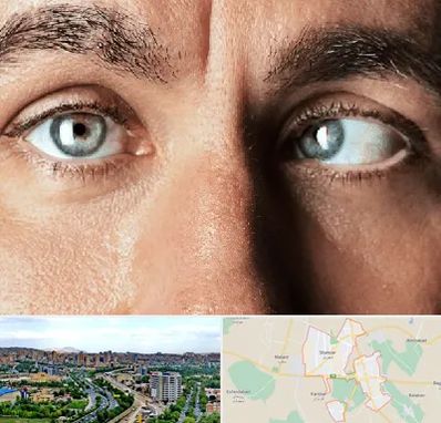 فوق تخصص استرابیسم در شهریار