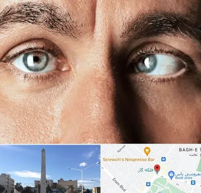 فوق تخصص استرابیسم در فلکه گاز شیراز