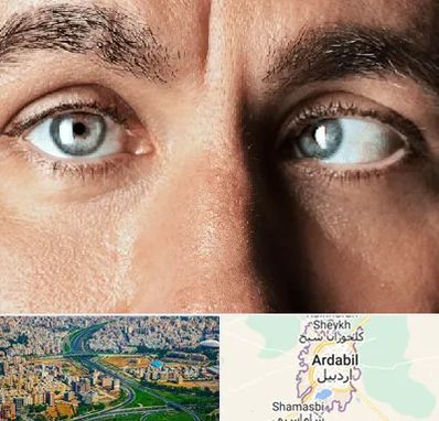 فوق تخصص استرابیسم در اردبیل