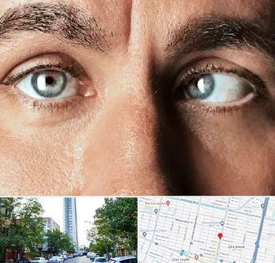 فوق تخصص استرابیسم در امامت مشهد