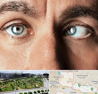 فوق تخصص استرابیسم در پردیس