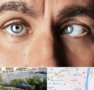 فوق تخصص استرابیسم در گلستان اهواز