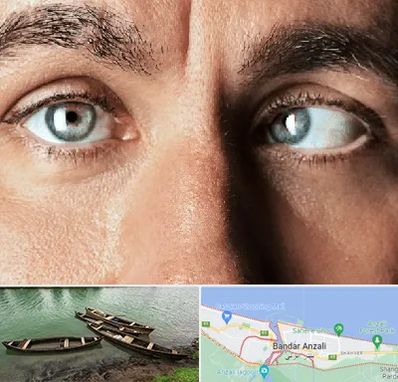 فوق تخصص استرابیسم در بندر انزلی