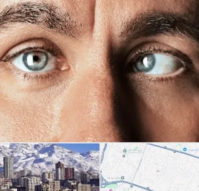 فوق تخصص استرابیسم در ازگل