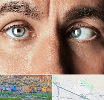 فوق تخصص استرابیسم در رشدیه تبریز