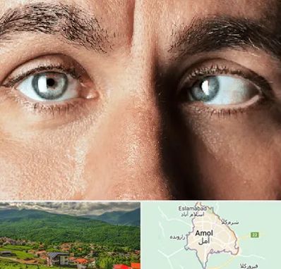 فوق تخصص استرابیسم در آمل