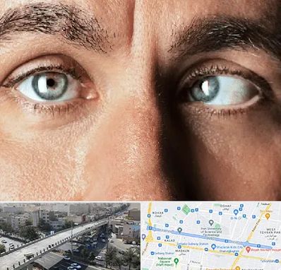 فوق تخصص استرابیسم در فرجام