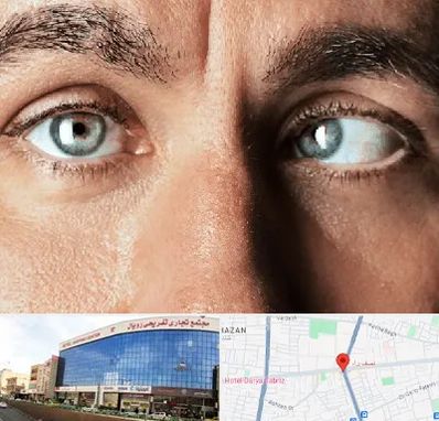 فوق تخصص استرابیسم در نصف راه تبریز