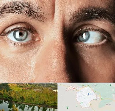 فوق تخصص استرابیسم در بهبهان