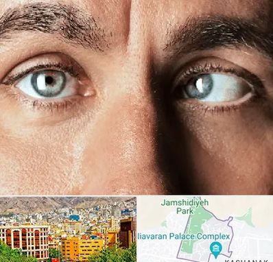 فوق تخصص استرابیسم در نیاوران 