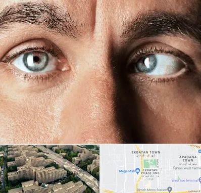 فوق تخصص استرابیسم در اکباتان 