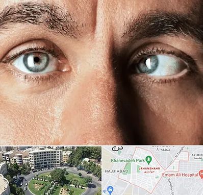 فوق تخصص استرابیسم در جهانشهر کرج 