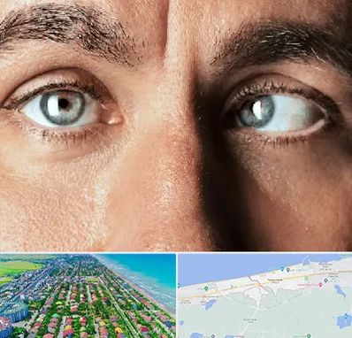 فوق تخصص استرابیسم در فریدونکنار